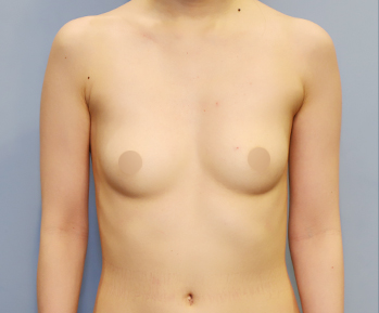 breast03 bna03 b