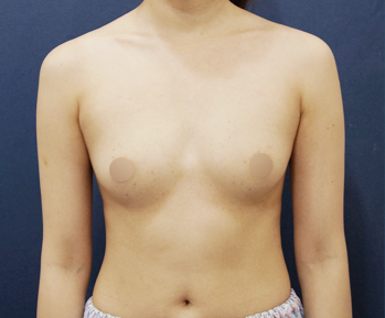 breast03 bna04 b