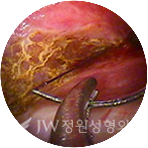breast03 cont03 02