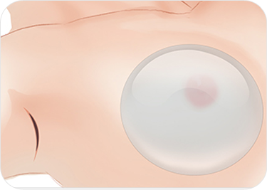 breast03 cont05 05