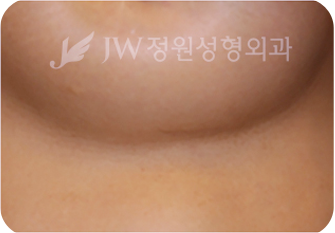 breast03 cont06 01