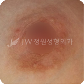 breast03 cont07 02