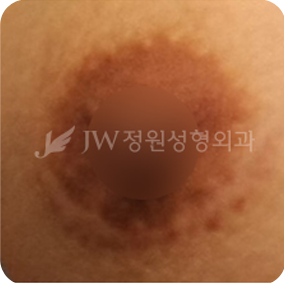 breast03 cont07 03