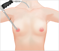 breast03 cont08 01