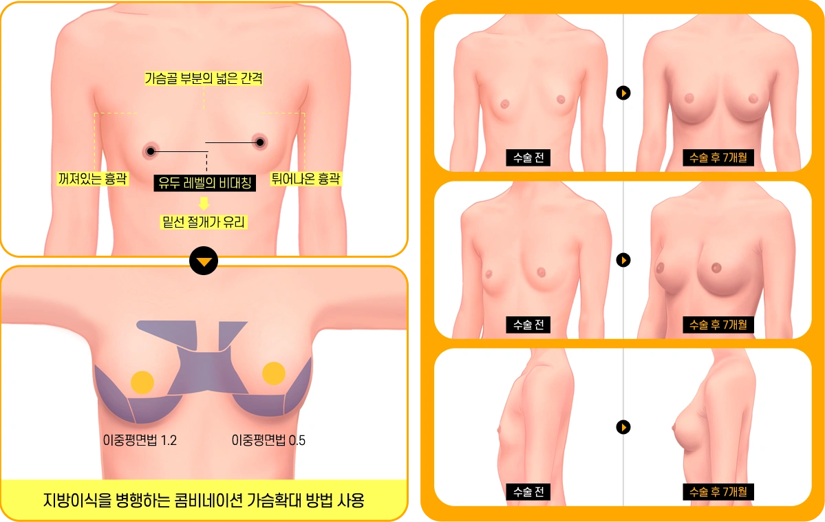 breast01 cont05
