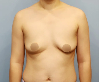 breast16 bna01 b