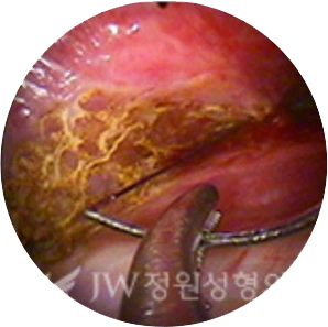 surgicalmetho