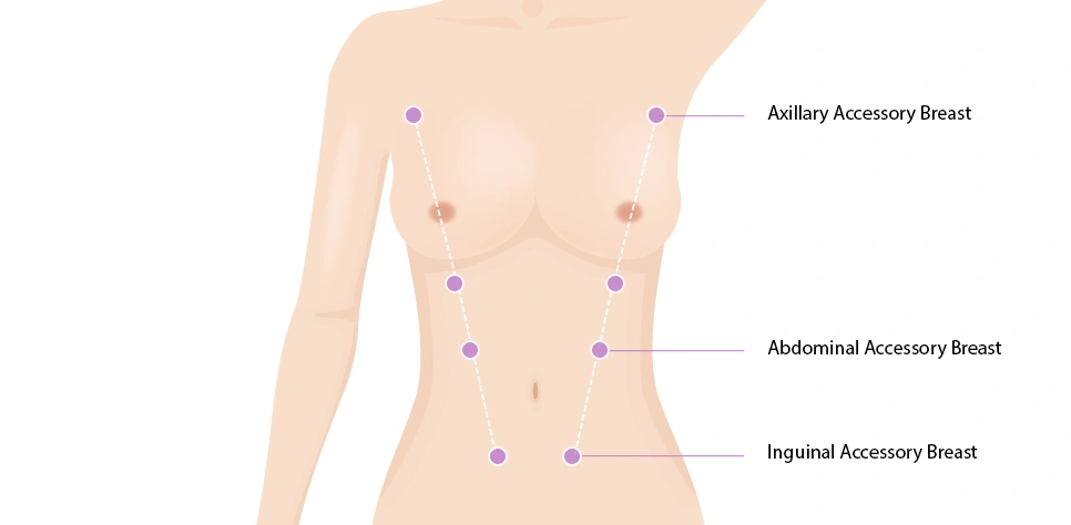 breast17 cont03 011