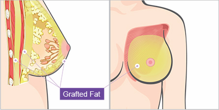 breast stem cell graft augmentation jw 3