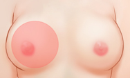 breast4 img1b