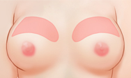 breast4 img1c