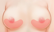 breast4 img1d