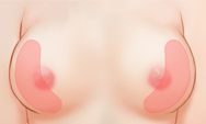 breast4 img1e