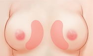 breast4 img1f