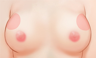 breast4 img1g